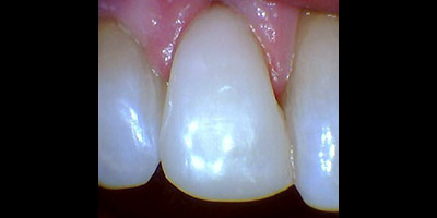 Closeup of repaired tooth and gums