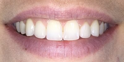 Bright teeth after whitening