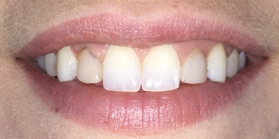 Yellow teeth before whitening