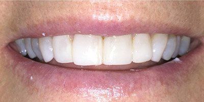 White and healthy teeth after