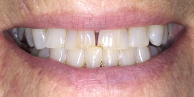 Gap between front teeth before