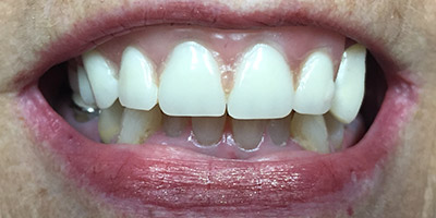 Unnatural looking front tooth treatment