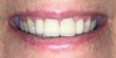 Repaired and brilliant white front teeth