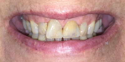 Damaged and dark colored front teeth