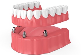 Diagram of implant denture in Corbin being placed