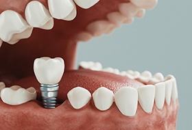 Diagram depicting how dental implants in Corbin are placed