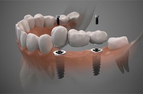 Digital illustration of implant bridge in Corbin