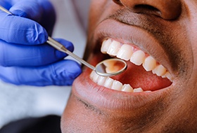 Closeup of patient during dental exam