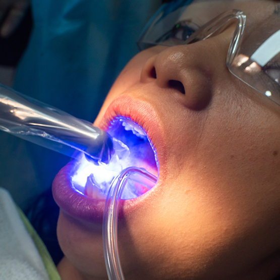 Dental patient receiving direct bonding
