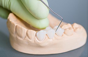 Model smile with dental bridge restoration