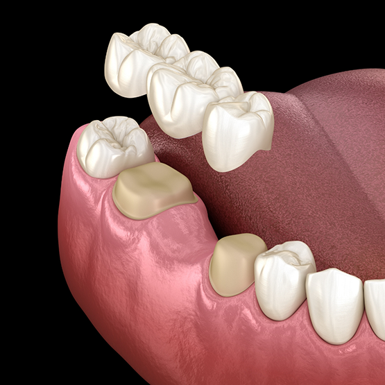 Illustration of a dental bridge replacing a missing tooth