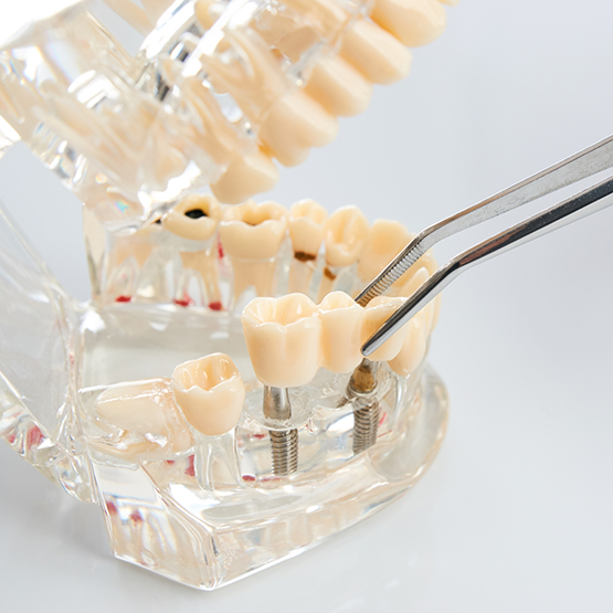 Tweezers placing a dental bridge in a model of the mouth