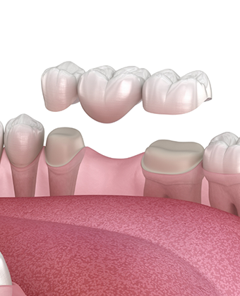 Illustration of a traditional dental bridge
