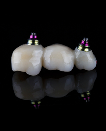 Dental bridge with implant attachments