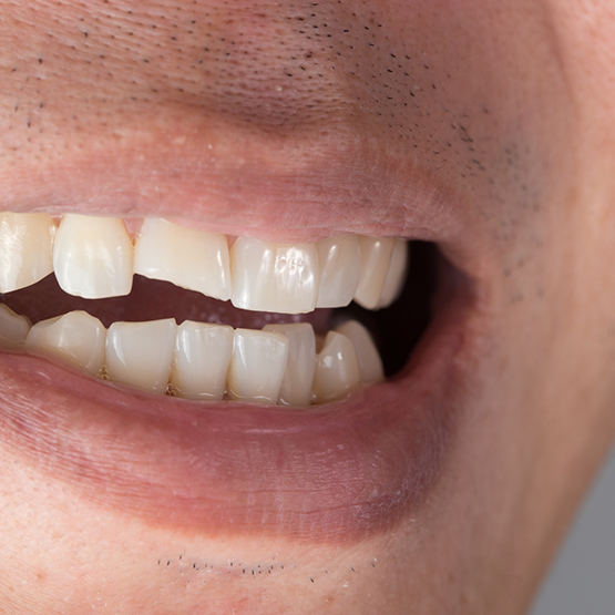 Close up of a man with a chipped front tooth