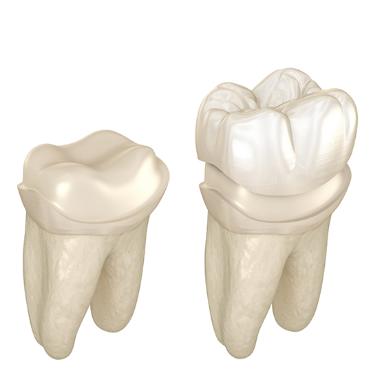 Illustration of a dental crown being fitted over a tooth