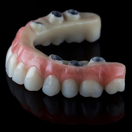 Full denture with implant attachments
