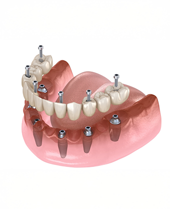 Illustration of a denture being secured onto six dental implants