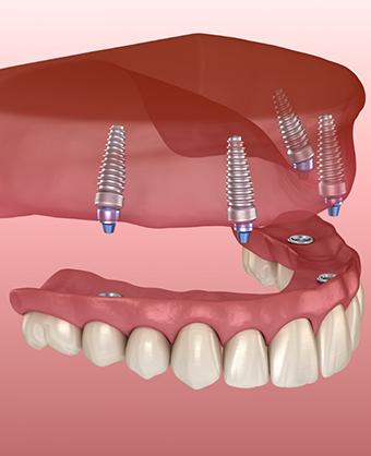 Illustration of a full denture supported by four implants