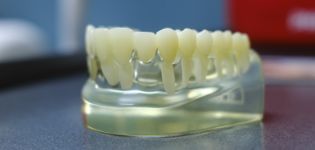 Model of the teeth with a dental bridge