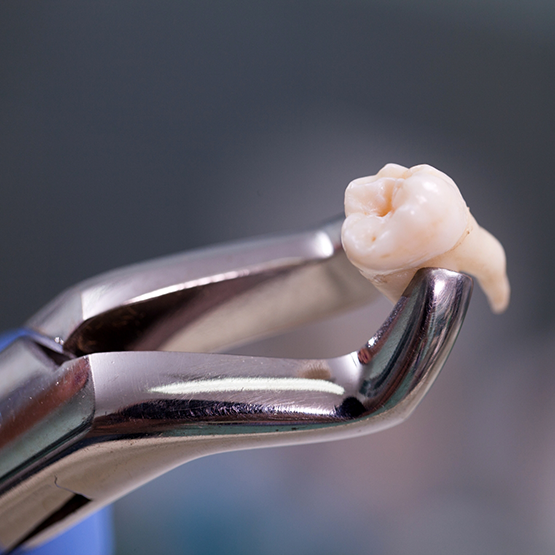 Dental forceps holding an extracted tooth