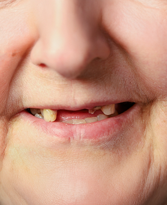 Close up of a smile with multiple missing teeth