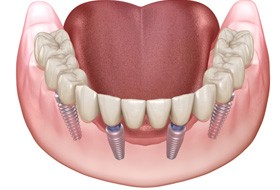 Implant denture for lower arch