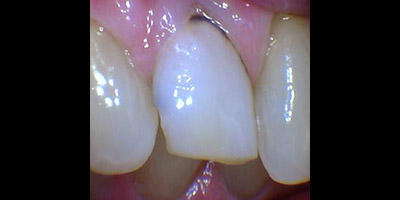 Closeup of damaged tooth and gums