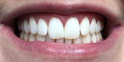 Bright teeth after whitening