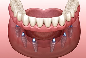 Illustration of implant dentures in Corbin, KY