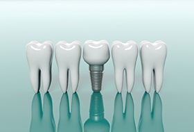 Model dental implant in Corbin next to line of model teeth for comparison