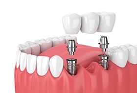 Diagram of implant bridge for multiple missing teeth in Corbin