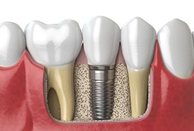 Diagram depicting dental implants in Corbin during osseointegration