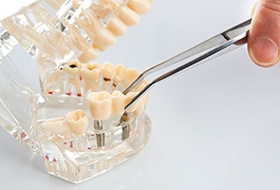 Closeup of dentist placing bridge on model dental implants in Corbin
