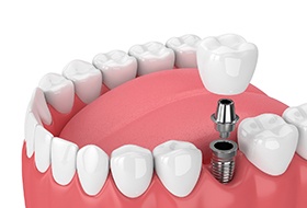 Diagram of single tooth dental implant in Corbin