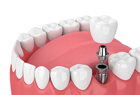 Diagram of single tooth dental implant in Corbin