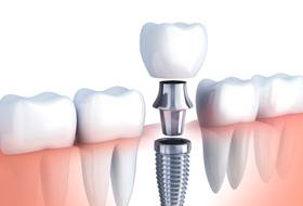 Illustration of implant, abutment, and crown between natural teeth