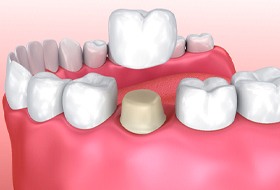 model of dental crown