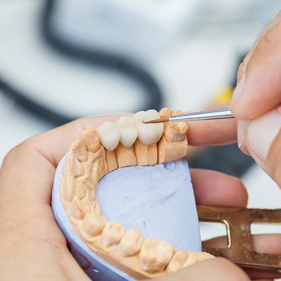 Dental lab worker adjusting a dental bridge