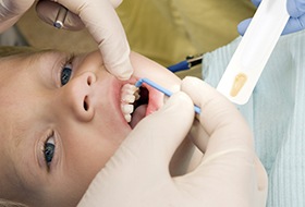 Child receiving fluoride treatment