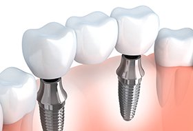 Animation of implant supported bridge