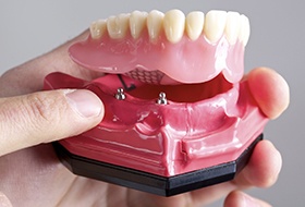 Model of implant supported denture