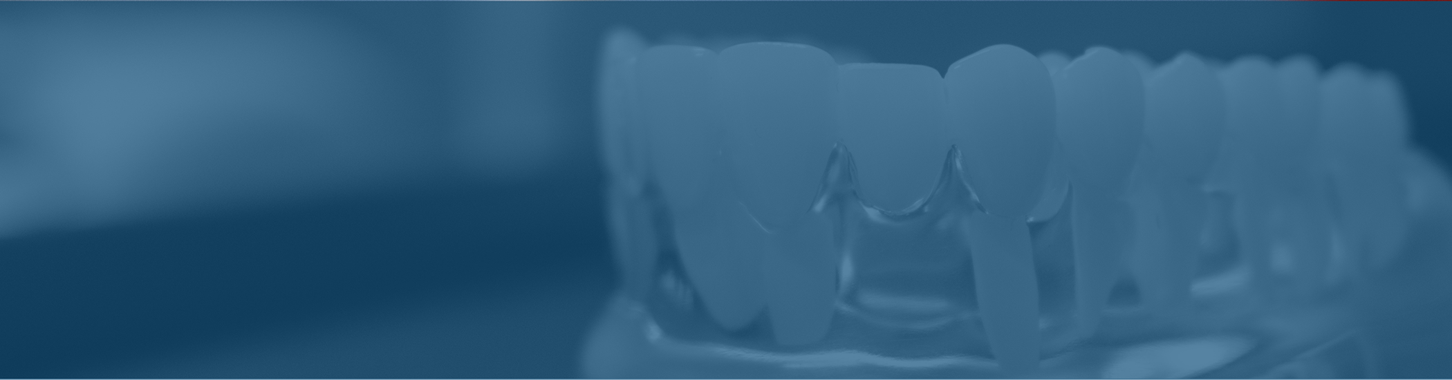 Model of the mouth with a dental bridge