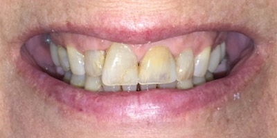 Smile with yellow and gray discoloration on several teeth