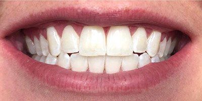 Smile after whitening slightly yellowed teeth