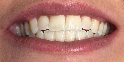 Smile with slightly yellowed teeth