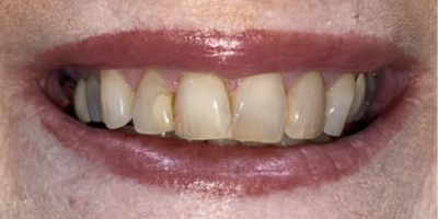 Close up of a smile with discolored teeth