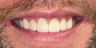 Smile after treating brown stains on the teeth