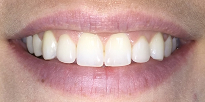 Smile after treating dark gray spots in the teeth