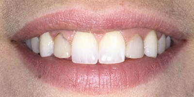 Smile with a few dark gray spots in the teeth